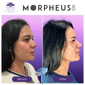 Before and after images showcasing the results of Morpheus8 treatment, highlighting significant skin tightening and rejuvenation on a woman's face, branded with Prime Vitality logo.
