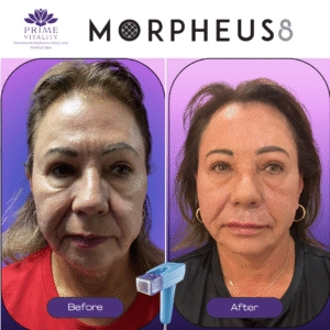 Before and after images of a woman showcasing the results of Morpheus8 treatment for skin rejuvenation, highlighting improved skin texture and reduced wrinkles, with branding from Prime Vitality.