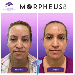 Before and after images showcasing Morpheus8 treatment results, demonstrating improved skin appearance and rejuvenation, featuring the Prime Vitality logo.