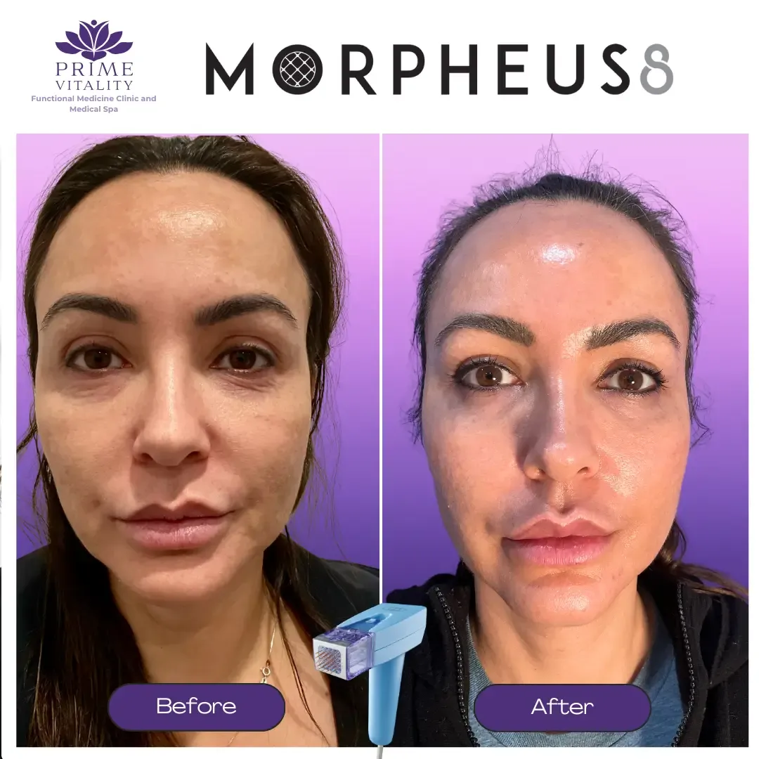 Before and after images showing facial rejuvenation results from Morpheus8 treatment at Prime Vitality, highlighting improved skin texture and tone, with a microneedling device depicted.