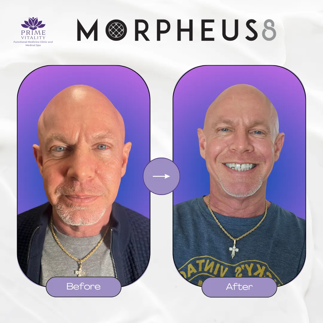 Before and after images of a male patient showcasing results from Morpheus8 treatment, highlighting improved skin texture and appearance, with visible reduction in fine lines and enhanced facial rejuvenation, branded with Prime Vitality logo.