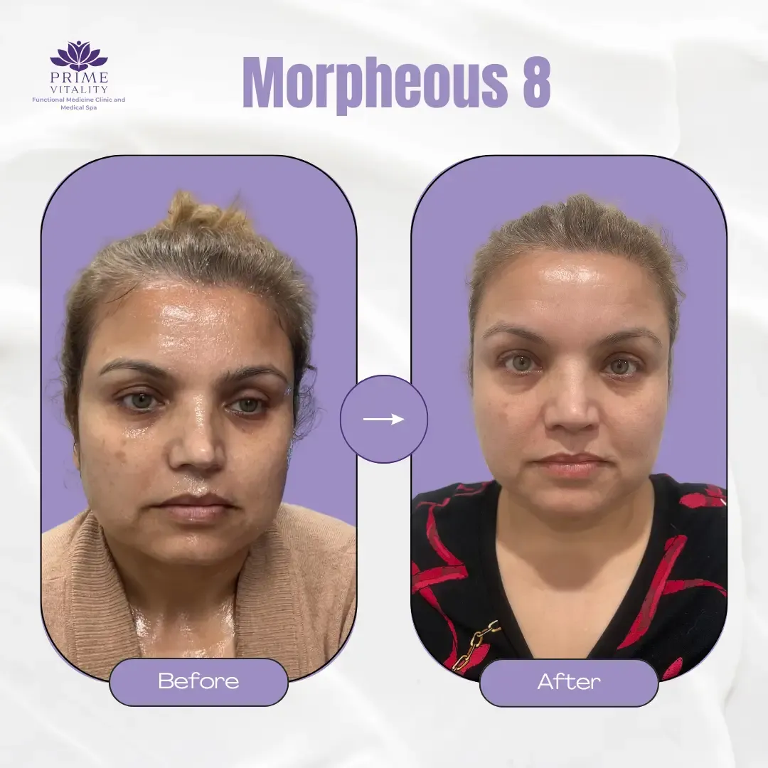Before and after comparison of Morpheus8 treatment results, showcasing improved skin texture and firmness, highlighting non-invasive skin rejuvenation by Prime Vitality.