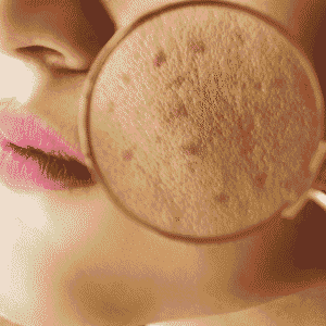 Acne Therapy