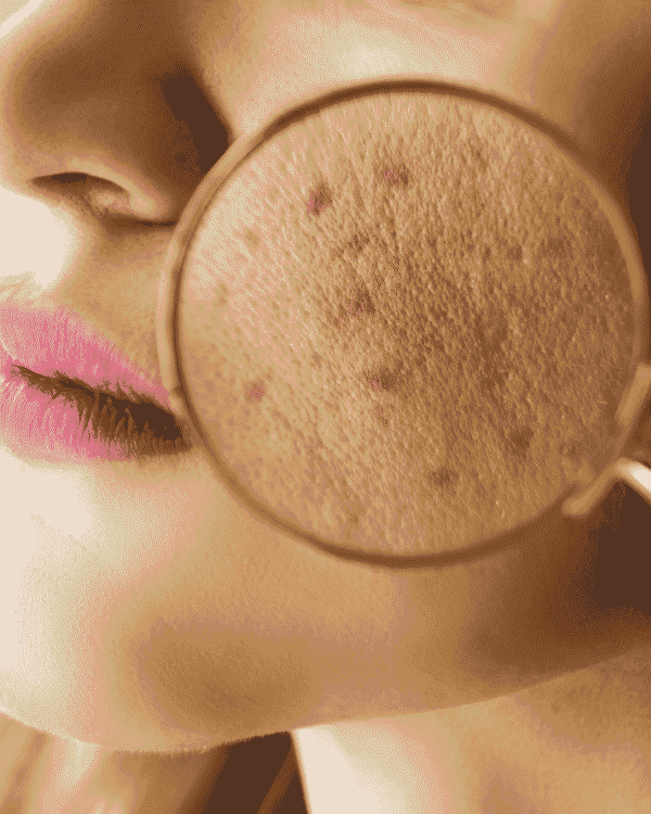 Acne Therapy