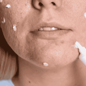 Acne Treatment