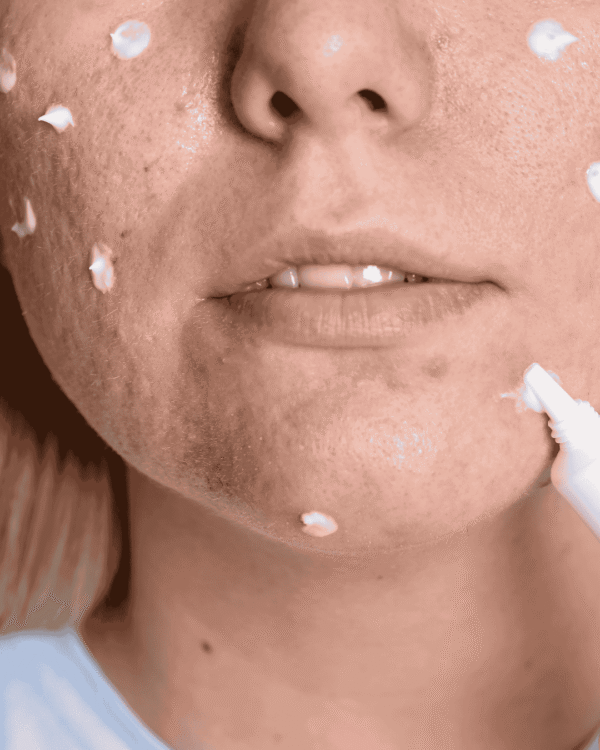 Acne Treatment