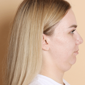 Double Chin Reduction Treatment