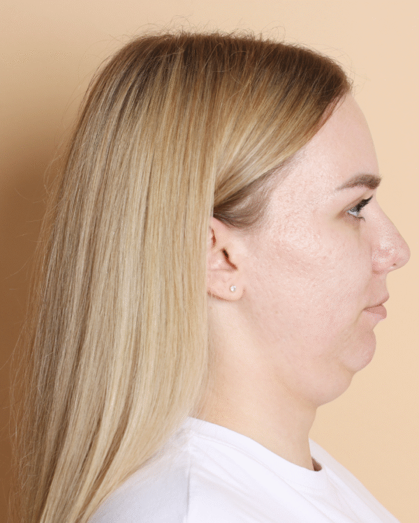 Double Chin Reduction Treatment