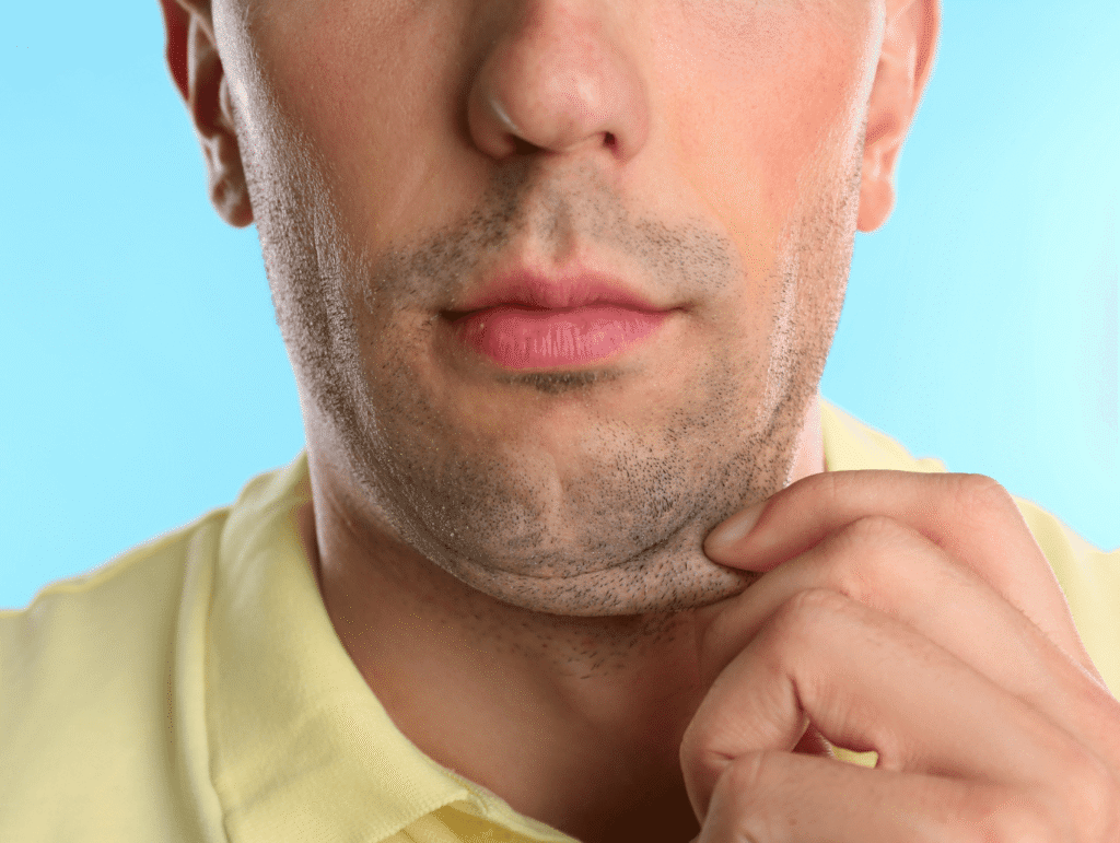 Double Chin Reduction